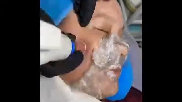 хиджама на лицо. смотреть онлайн