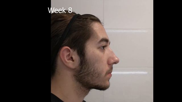Minoxidil Beard Growth - 3 Month Transformation - Timelapse (BEFORE and AFTER) смотреть онлайн