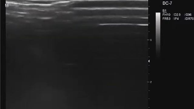 Энтезопатия кальцифицирующая тендинопатия ахиллова сухожилия с обеих сторон