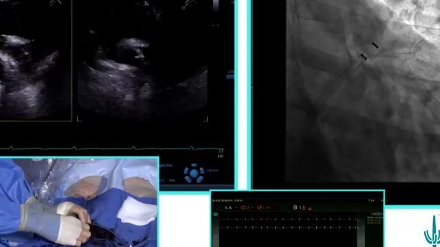 AcQCross™: Watchman Live Case 2 with AcQCross — Dr. Thomas Waggoner смотреть онлайн