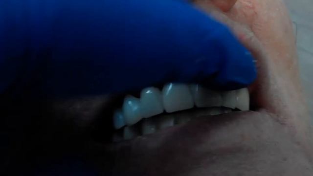 Протезирование пациента "С" металлоакриловым мостовидным протезом на в/ч. 4- я стоматология. смотреть онлайн