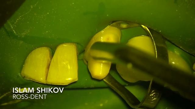 Адгезивная фиксация коронки смотреть онлайн