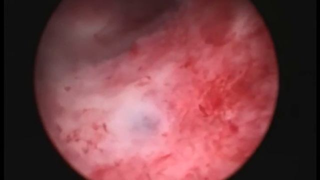 Эндометриоз, аденомиоз, гиперплазия эндометрия смотреть онлайн