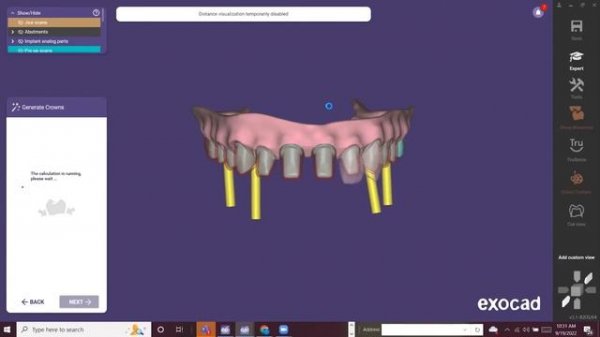 exocad Hacks for All On X / All On Four Cases | EVIDENT Lab-To-Lab Education Series (Ep 92)