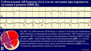 Тема 30.3. Принципы кардиостимуляции, ЭКГ при кардиостимуляции.