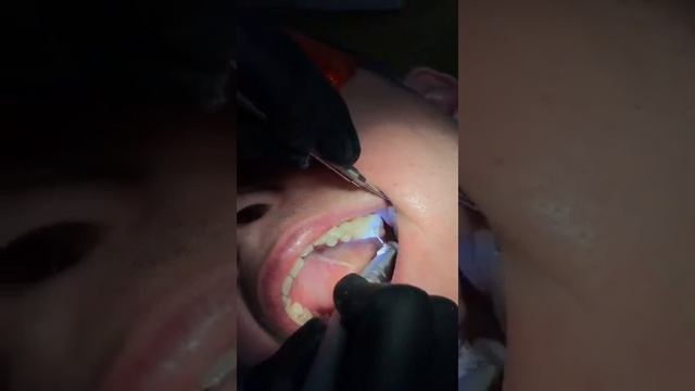 Препарирование кариозной полости смотреть онлайн