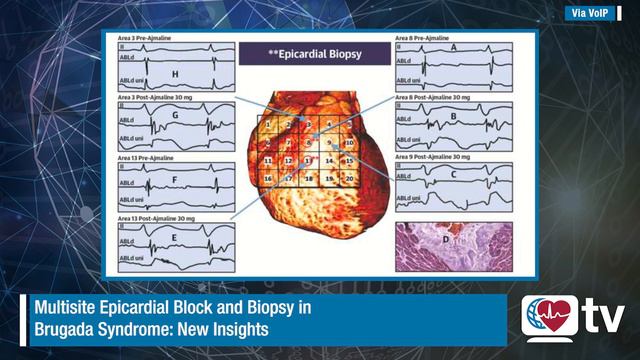 HRStv Update: March 2022 Heart Rhythm Journal (Brugada Syndrome) смотреть онлайн