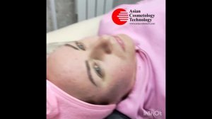 Микроигольчатый РФ, (игольчатый рф) видеоурок