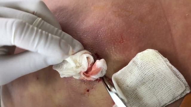 КАК ОН С ЭТИМ ЖИЛ?? | АБСЦЕДИРУЮЩИЙ КАРБУНКУЛ смотреть онлайн