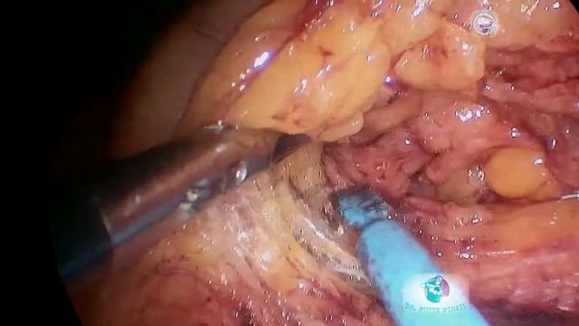 Lap. Anterior Resection For Rectal Cancer, LCA Preservation/Лап. резекция прямой кишки, сохр. ЛОА смотреть онлайн