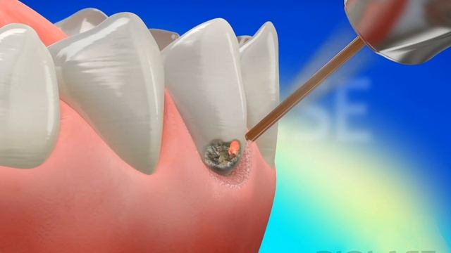 Restorative Class V - Waterlase Laser Dentistry смотреть онлайн