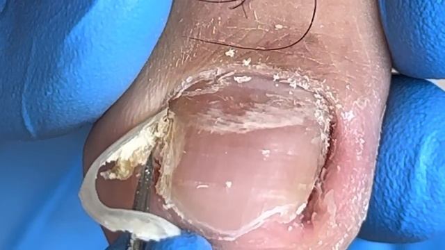 Thoroughly cleans impurities on both sides of toenails【Xue Yidao】 смотреть онлайн