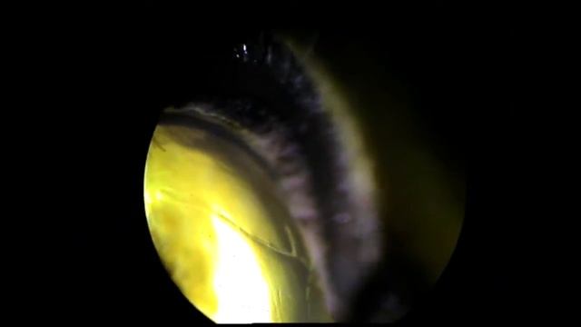 Герпетический древовидный кератит. смотреть онлайн