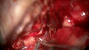 Артериальная аневризма бифуркации средней мозговой артерии