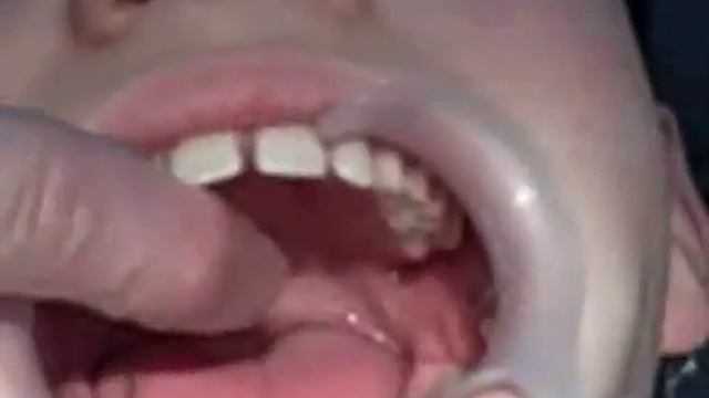 Getting My Braces! Stage 1 The Palate Expander смотреть онлайн