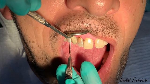 Composite Restoration Class 5