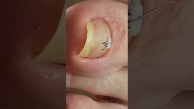 Кленина Наталья: "коррекция вросшего ногтя. смотреть онлайн