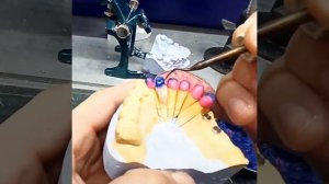 Процесс изготовления каркасов колпачков для металлокерамики.