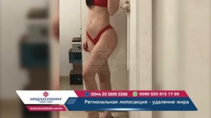 Региональная липосакция  / удаление жира