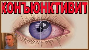 КОНЪЮНКТИВИТ