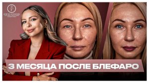 3 месяца после круговой блефаропластики