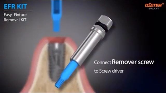 Osstem Implant All Kits