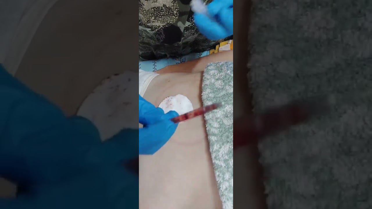 Гирудокосметология-наш ответ ботоксу. смотреть онлайн