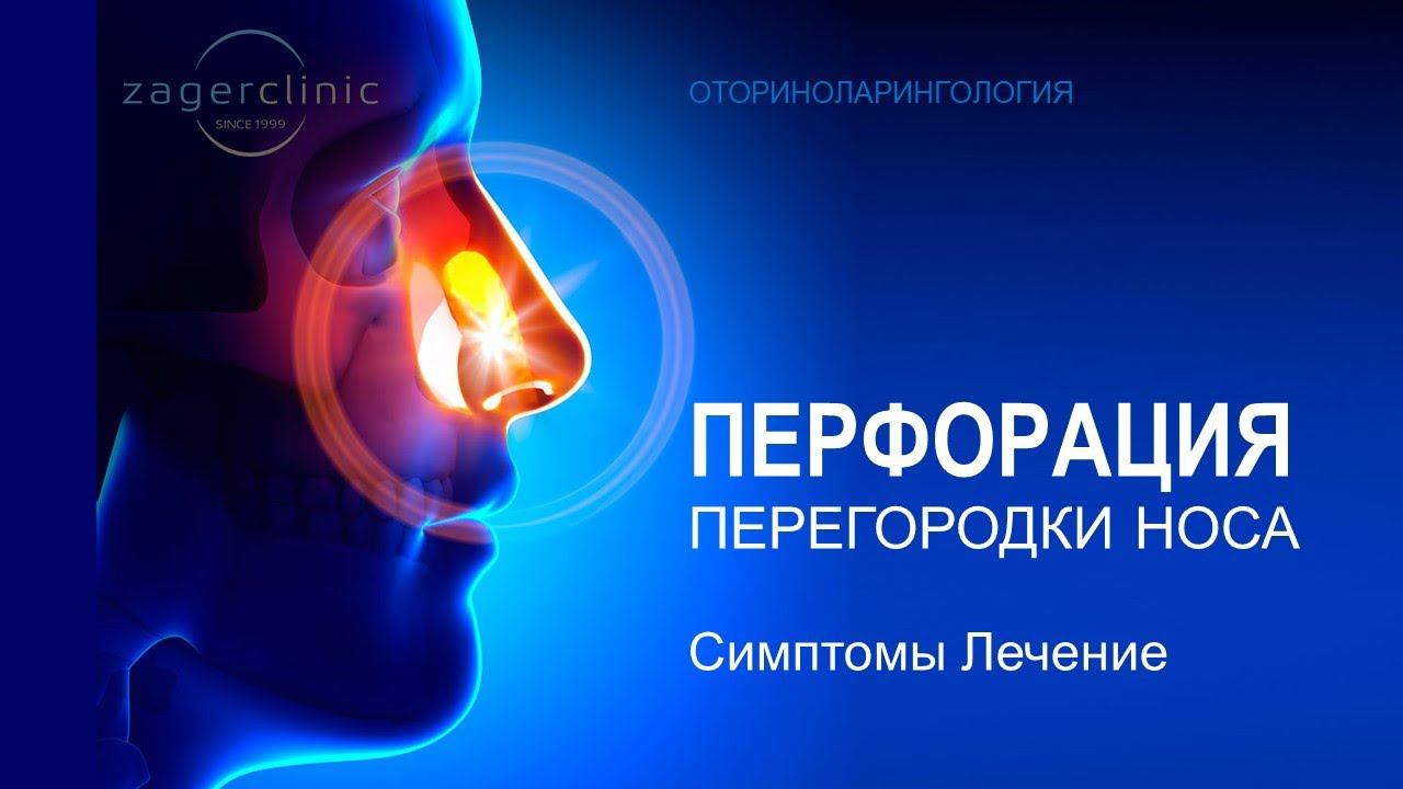 Перфорация перегородки носа | Симптомы, особенности лечения смотреть онлайн