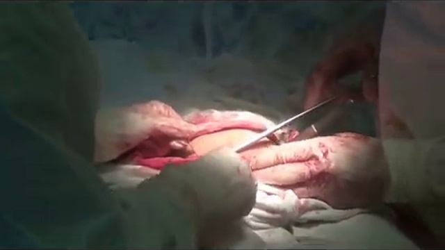 Кесарево сечение 2.wmv
