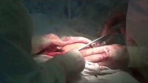 Кесарево сечение 2.wmv