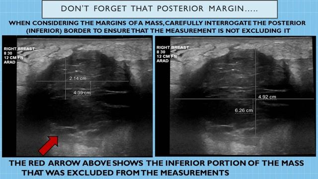 Breast Ultrasound - Measuring Breast Masses (Do's & Don'ts) | Registry Review Series смотреть онлайн