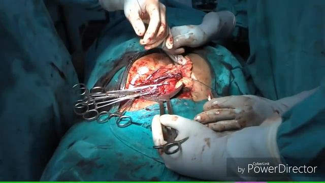 Caesarean Section(LSCS)