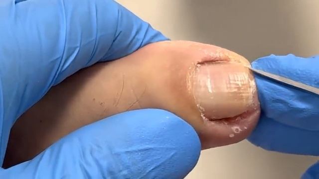Chatting Patient Repairs Her Ingrown Nails【Xue Yidao】