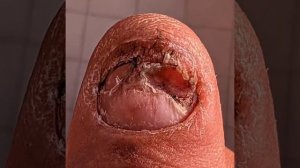 Ноготь вырос за 4 месяца.