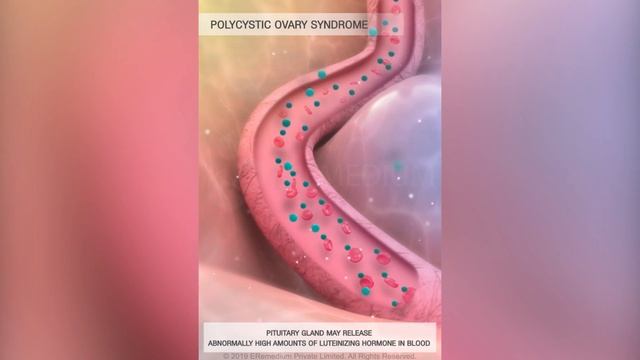 What is Polycystic Ovary Syndrome (PCOS) | 3D Guide смотреть онлайн