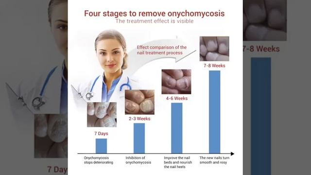 LANBENA Nail Repair Essence Serum Anti Fungal Nail Treatment Remove Onychomycosis Nourishin trendin смотреть онлайн