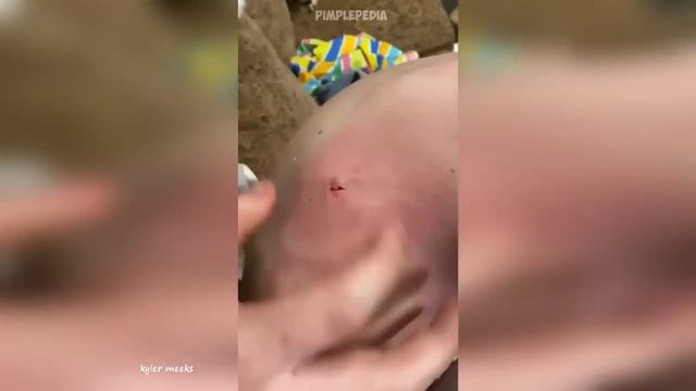 Popping Huge Blackheads and Pimple Popping - Best Pimple Popping Videos 25 смотреть онлайн