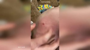 Popping Huge Blackheads and Pimple Popping - Best Pimple Popping Videos 25