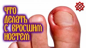 ЧТО ДЕЛАТЬ С ВРОСШИМ НОГТЕМ В ДОМАШНИХ УСЛОВИЯХ. Лечение Вросшего Ногтя.mp4