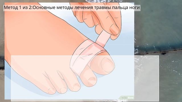 Как лечить ушиб пальцев ног смотреть онлайн