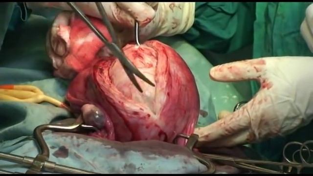 Myomectomy - remove and innoculate the myoma смотреть онлайн