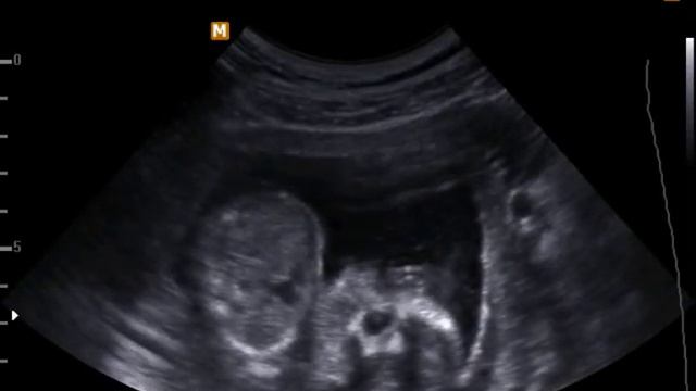 3D УЗИ ,17 неделя беременности смотреть онлайн