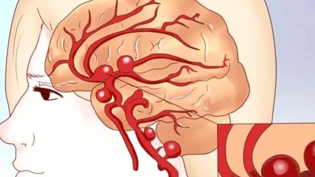 ЭТОТ ПРОДУКТ ЧИСТИТ СОСУДЫ ОТ ХОЛЕСТЕРИНА! ДОСТАТОЧНО СЪЕДАТЬ ВСЕГО ЛИШЬ ПО 1 ДОЛЬКЕ КАЖДЫЙ ДЕНЬ! смотреть онлайн