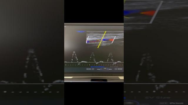 Идеальный кровоток в артерии несмотря на генетический риск тромбоза. Узи сосудов. Флеболог Москва смотреть онлайн