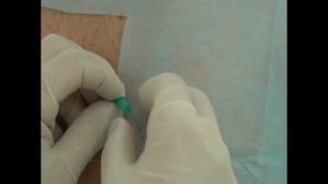 паравертебральная блокада с катетеризацией