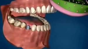 Циркониевые коронки на зубы (установка)