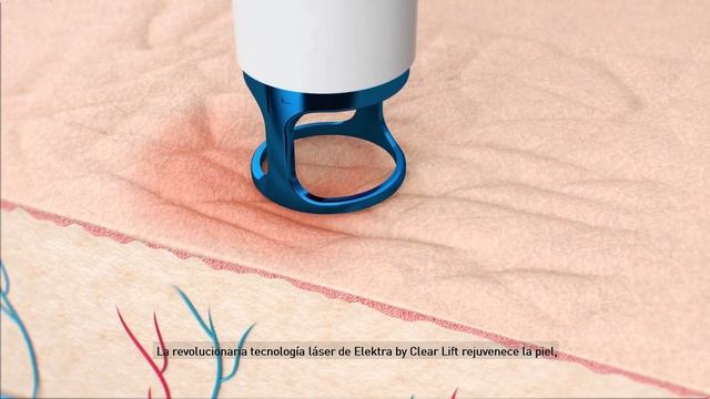 Elektra by ClearLift, tratamiento de rejuvenecimiento de la piel смотреть онлайн