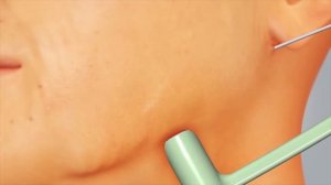 Фейс Тайт - радиочастотная липосакция с подтяжкой кожи