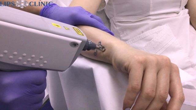 Удаление татуировок лазером