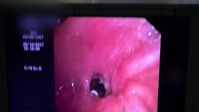 Аспергиллез легкого. Aspergillosis of the lung. смотреть онлайн